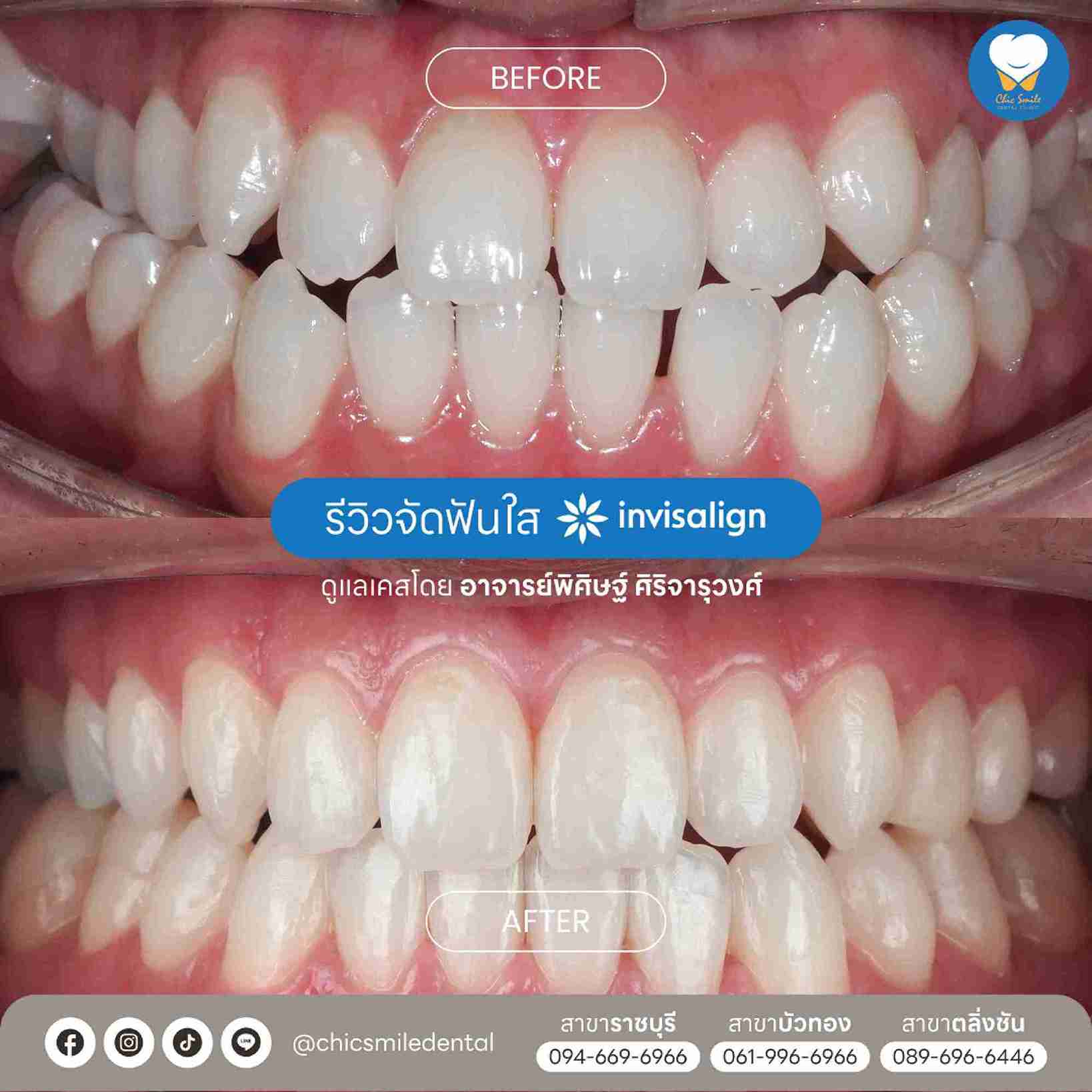 Chic - Bf&At จัดฟันใส 10-02-25-03