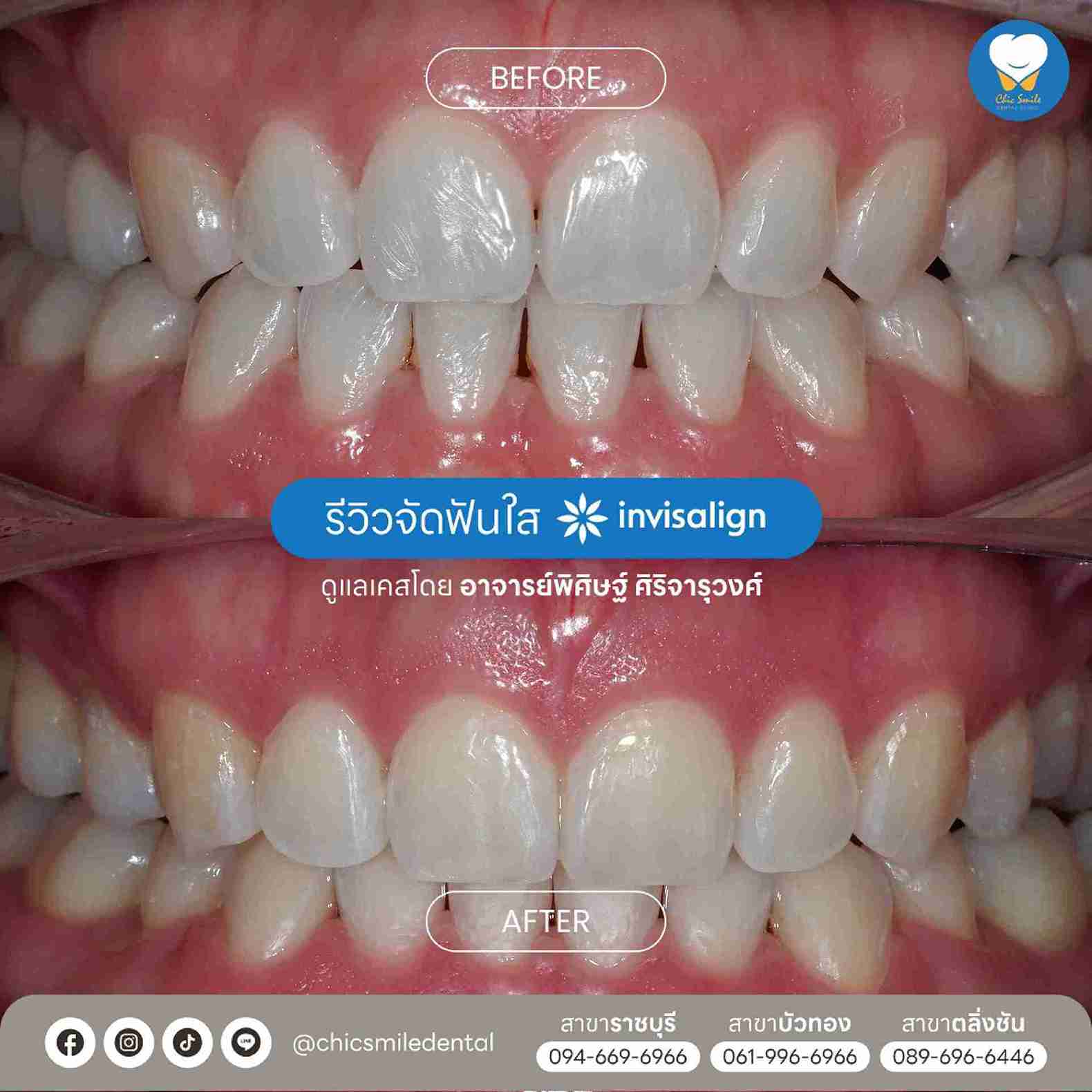 Chic - Bf&At จัดฟันใส 10-02-25-06