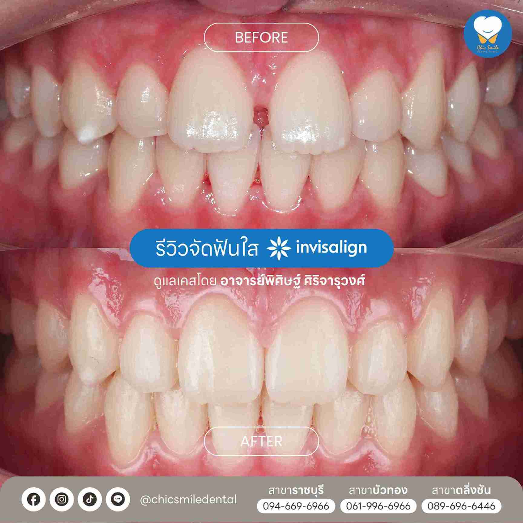 Chic - Bf&At จัดฟันใส 10-02-25-14