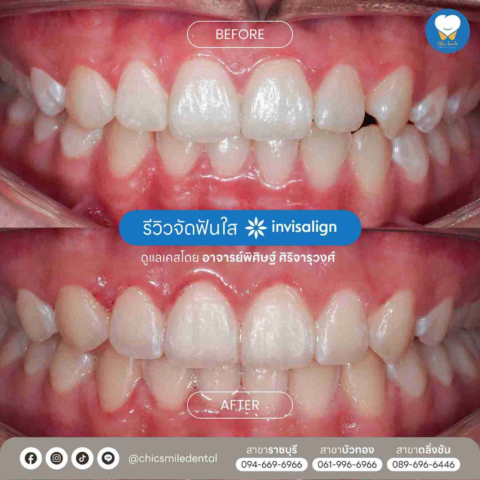 Chic - Bf&At จัดฟันใส 10-02-25-15
