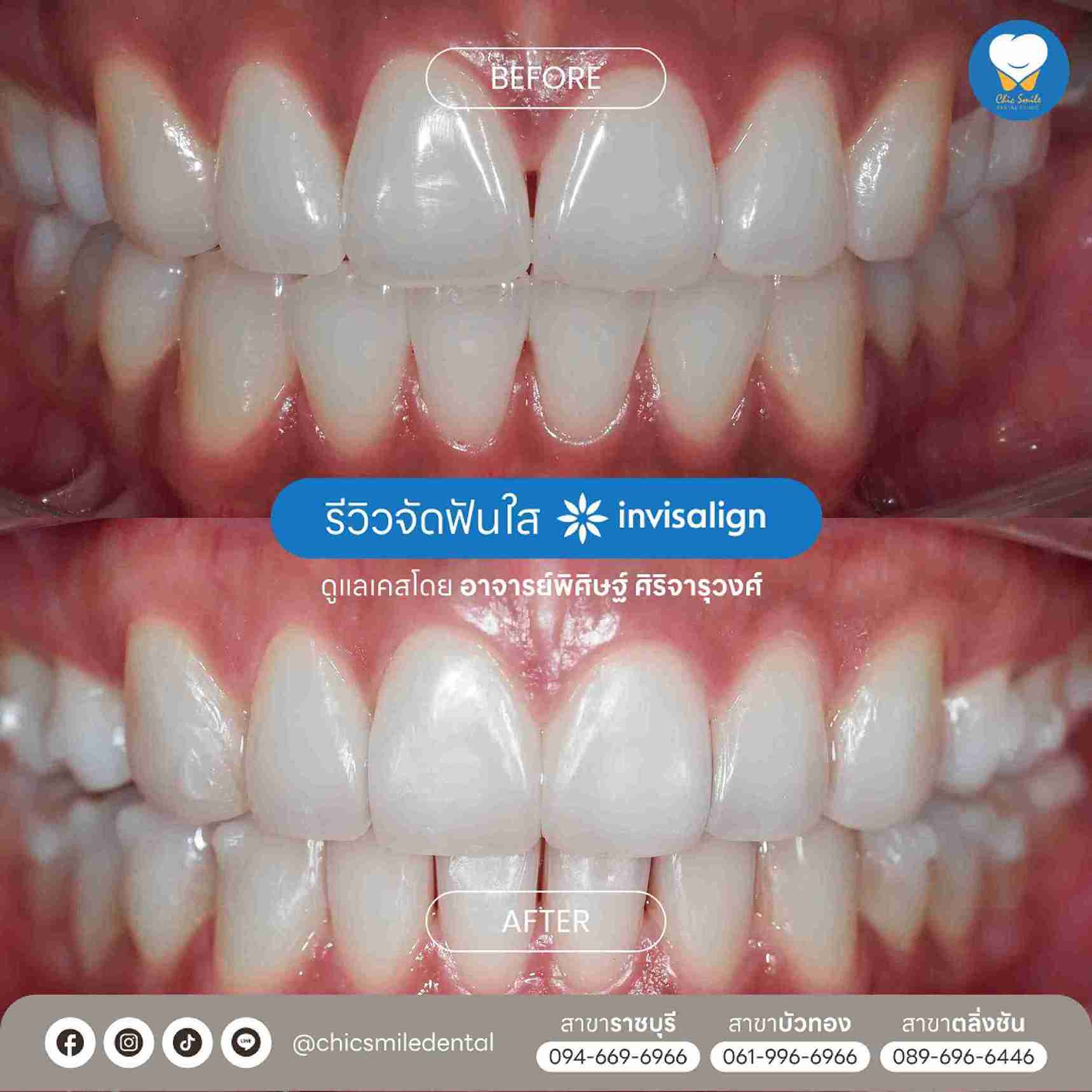 Chic - Bf&At จัดฟันใส 10-02-25-18