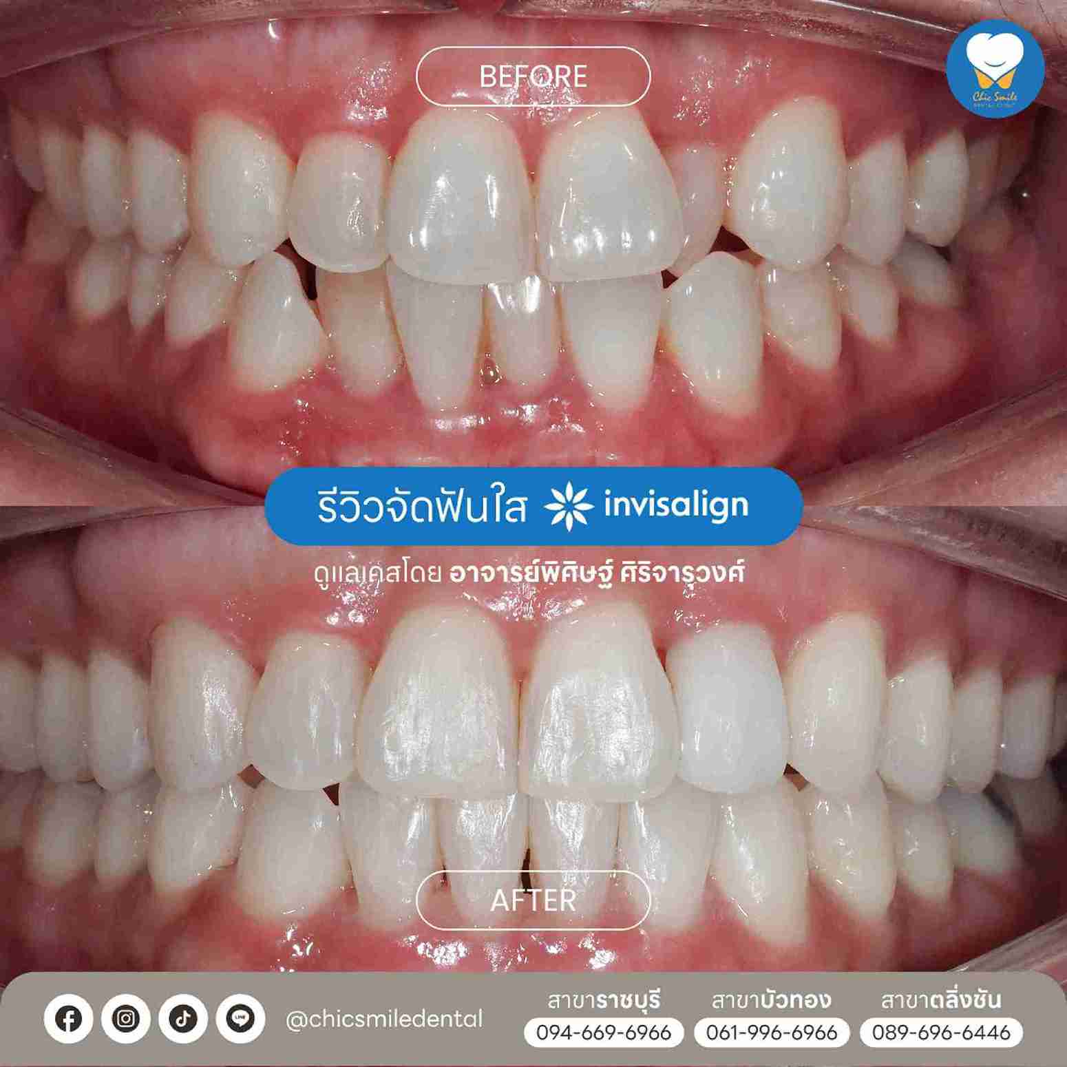 Chic - Bf&At จัดฟันใส 10-02-25-19