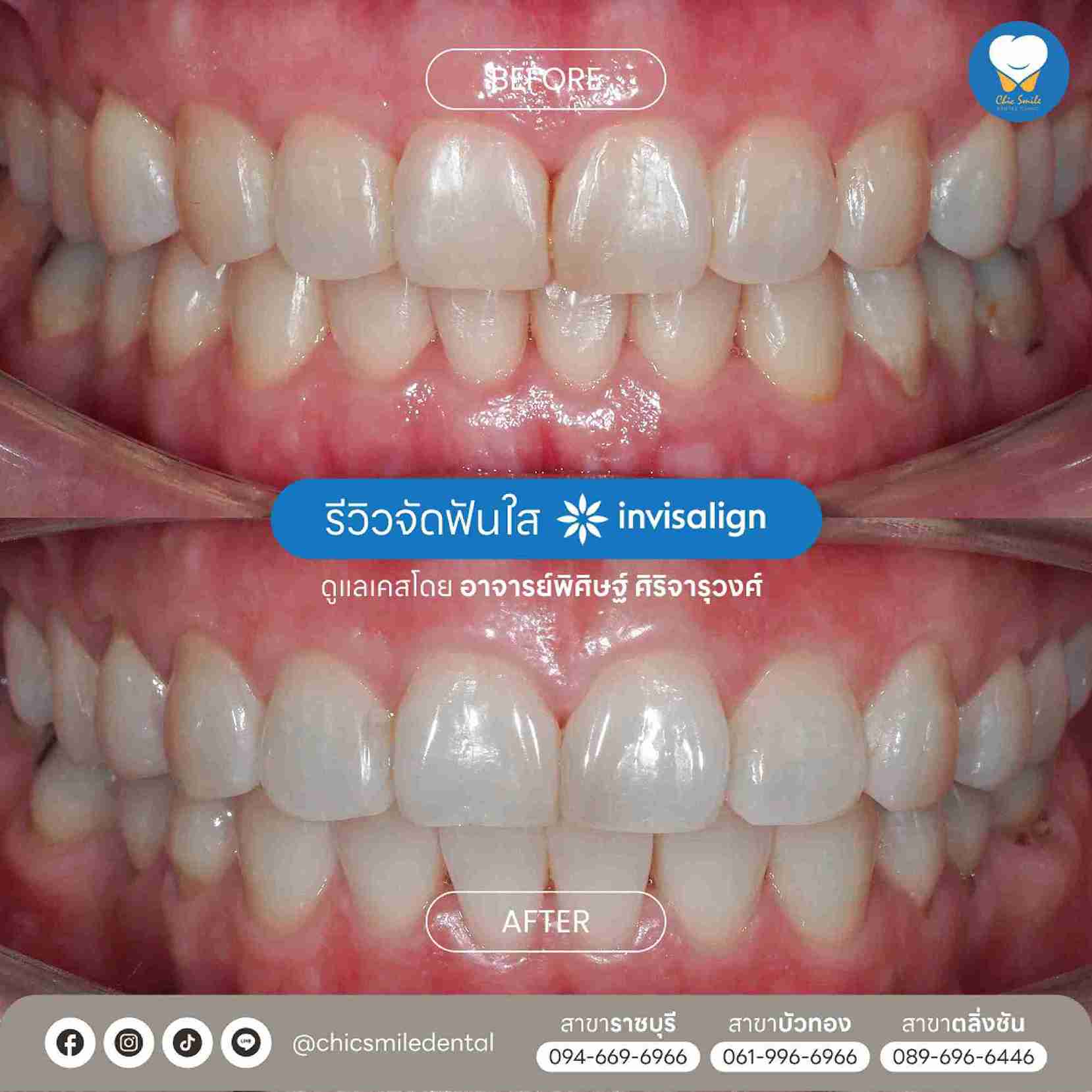 Chic - Bf&At จัดฟันใส 10-02-25-21