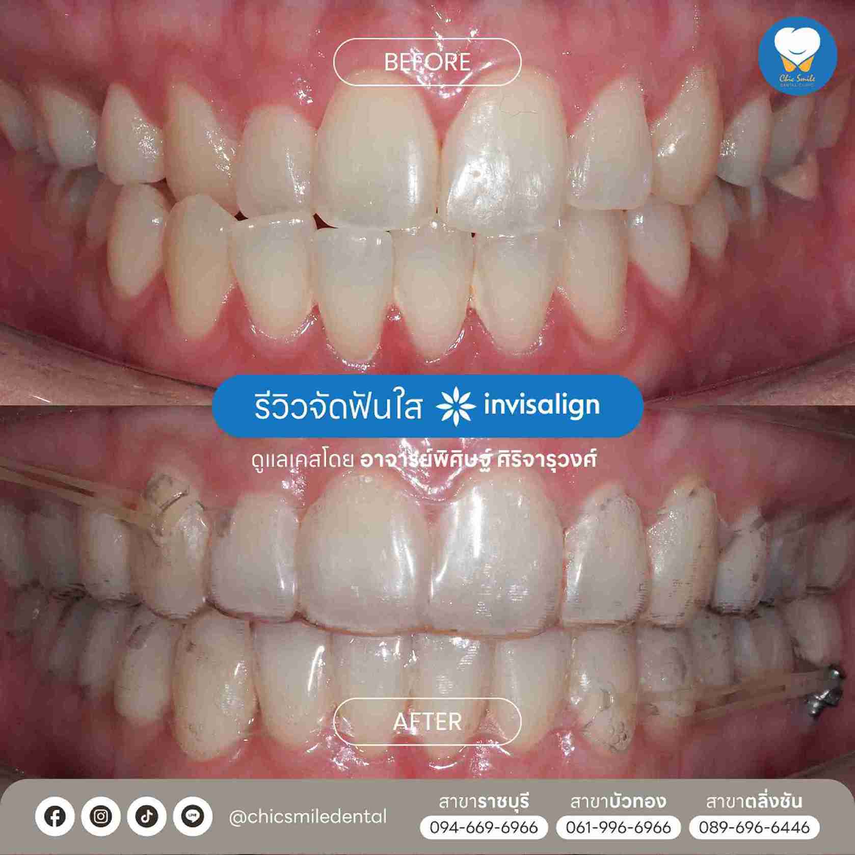 Chic - Bf&At จัดฟันใส 10-02-25-23