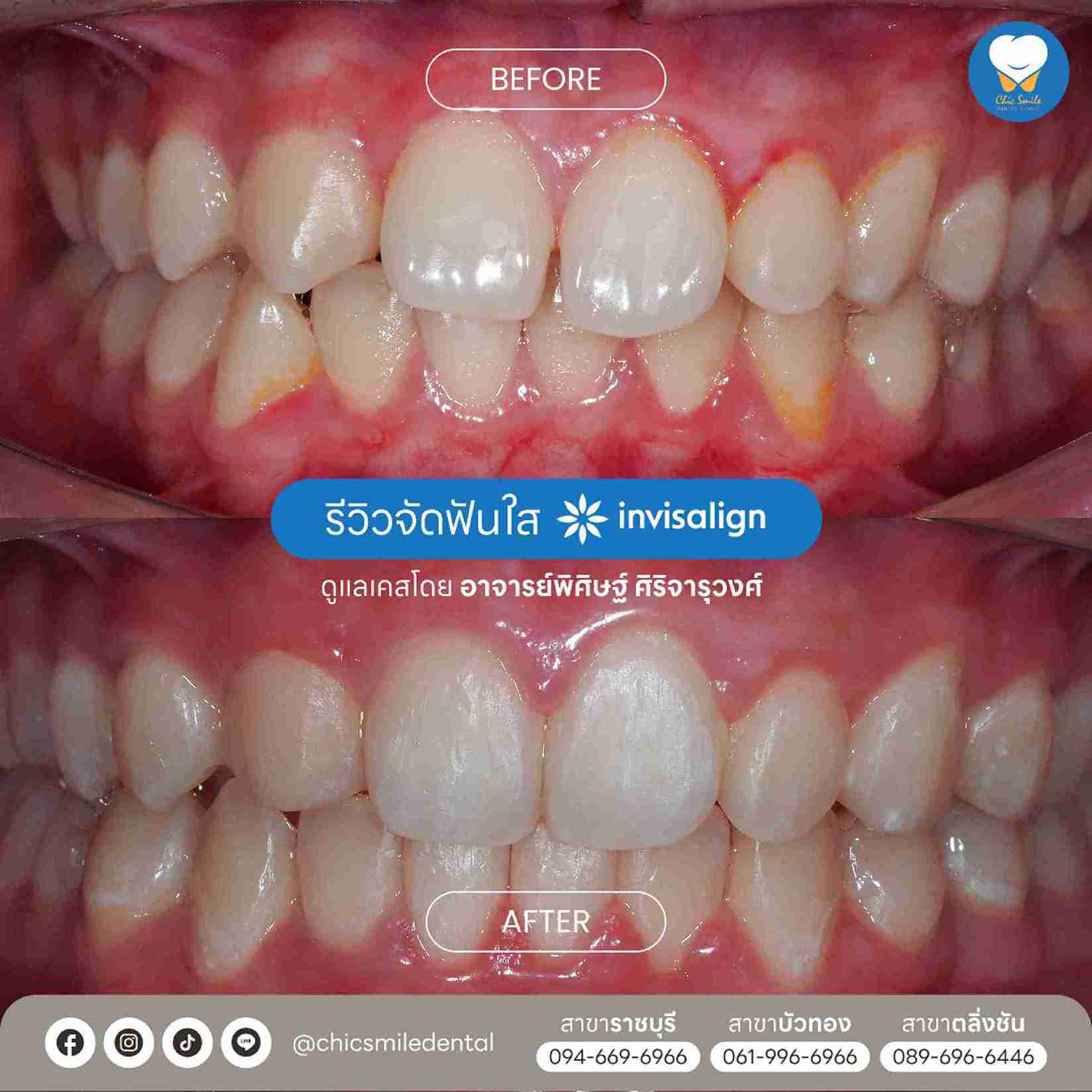 Chic - Bf&At จัดฟันใส 10-02-25-24