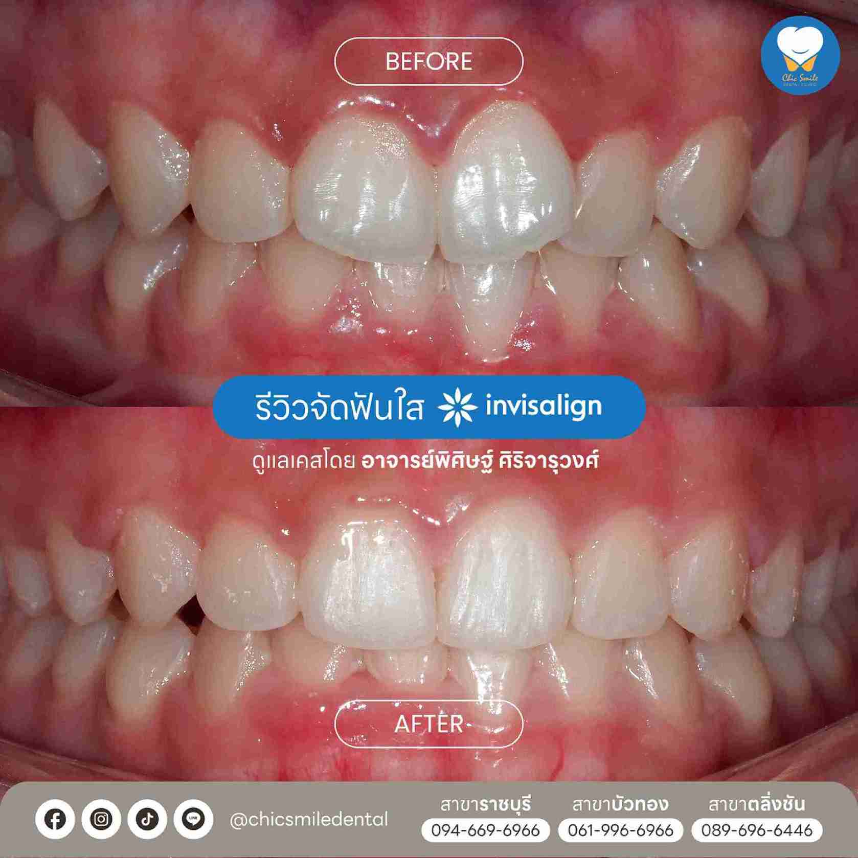Chic - Bf&At จัดฟันใส 10-02-25-26