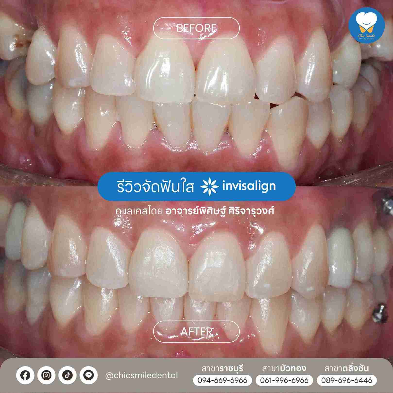 Chic - Bf&At จัดฟันใส 10-02-25-27