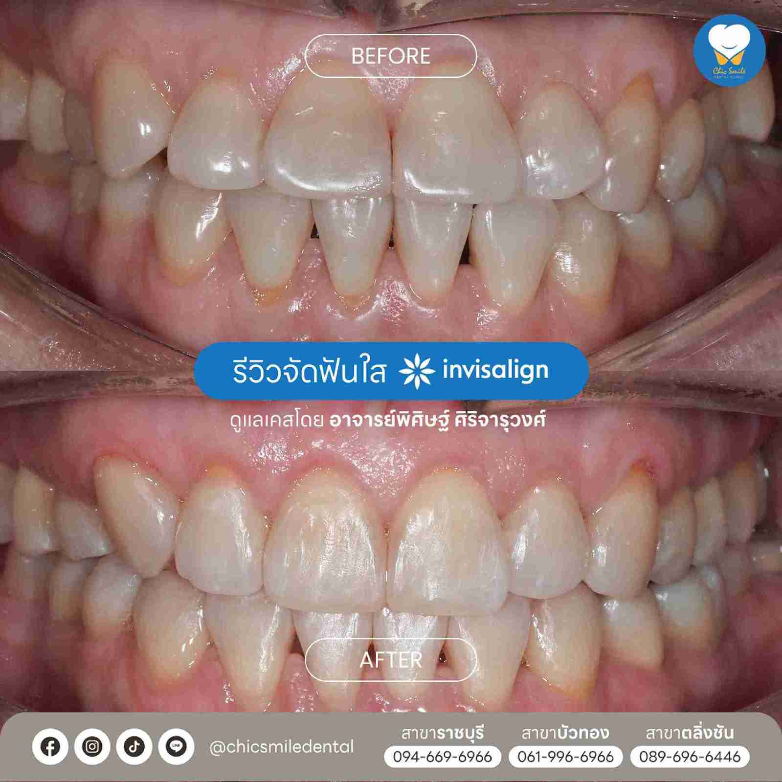 Chic - Bf&At จัดฟันใส 10-02-25-28