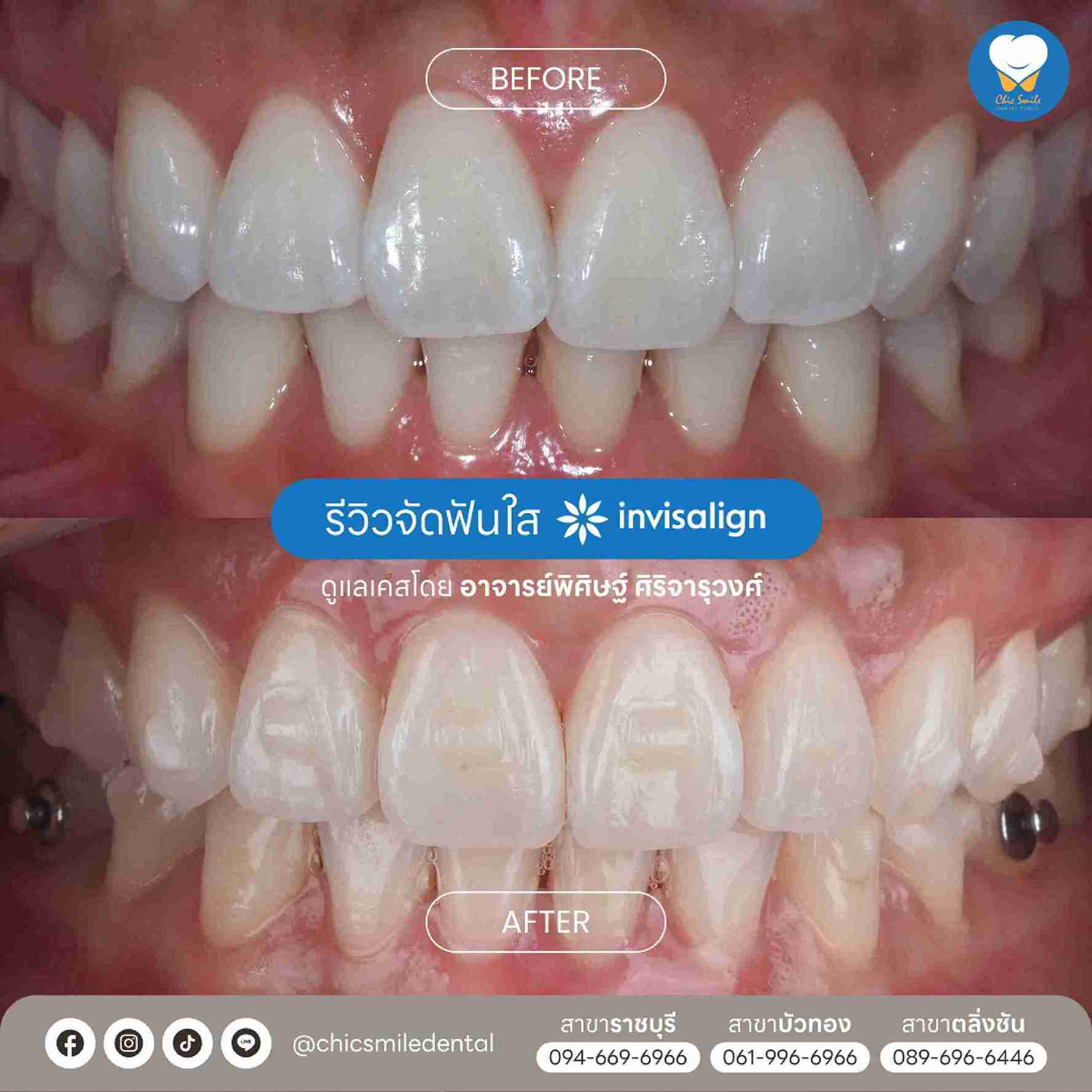 Chic - Bf&At จัดฟันใส 10-02-25-29