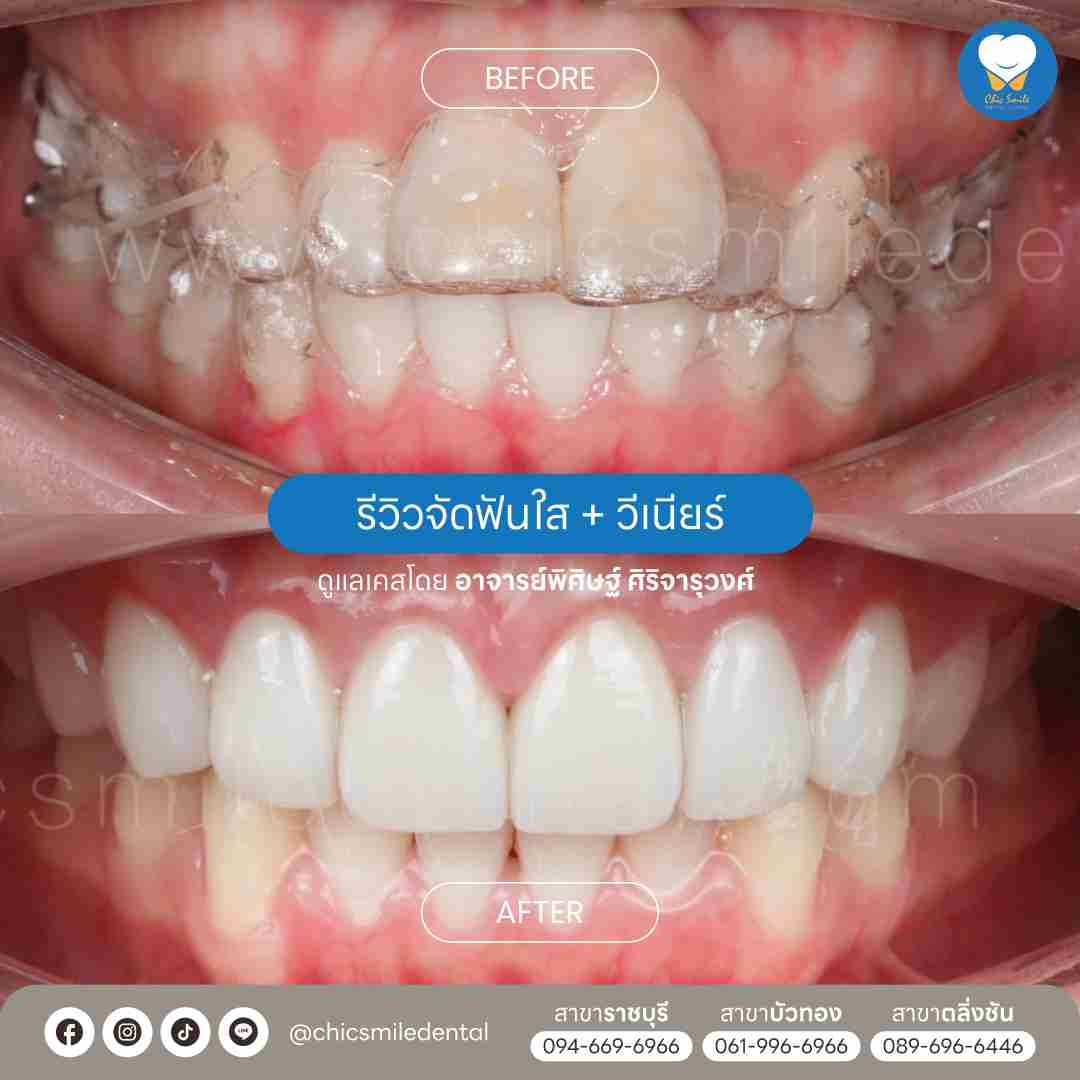 Chic smile case02_6_11zon