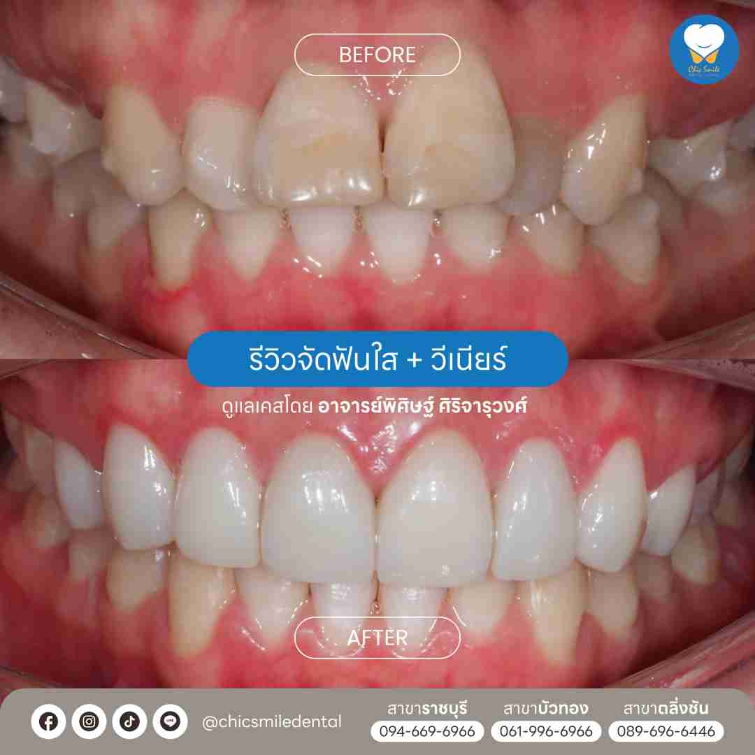 Chic smile case03_5_11zon