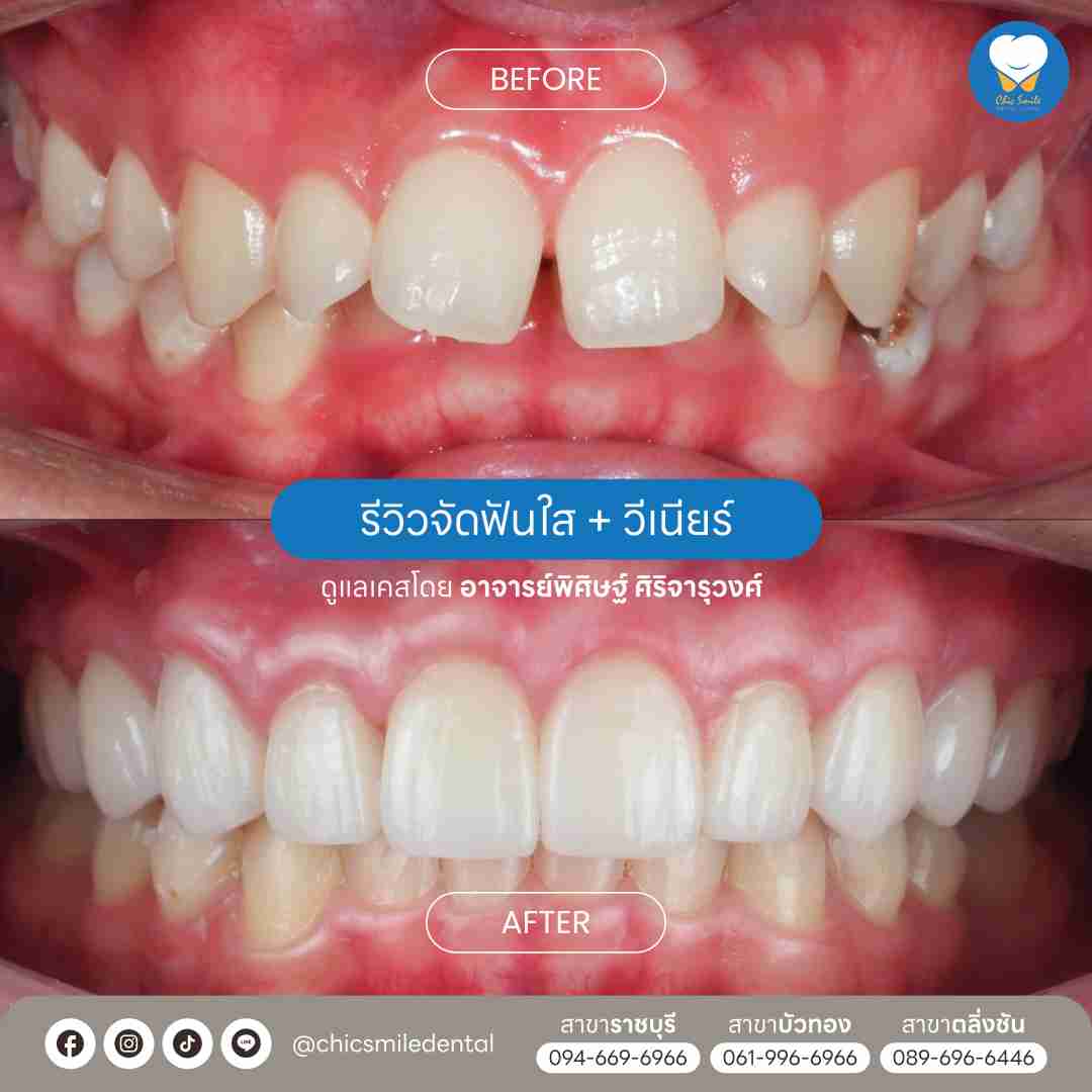 Chic smile case04_4_11zon