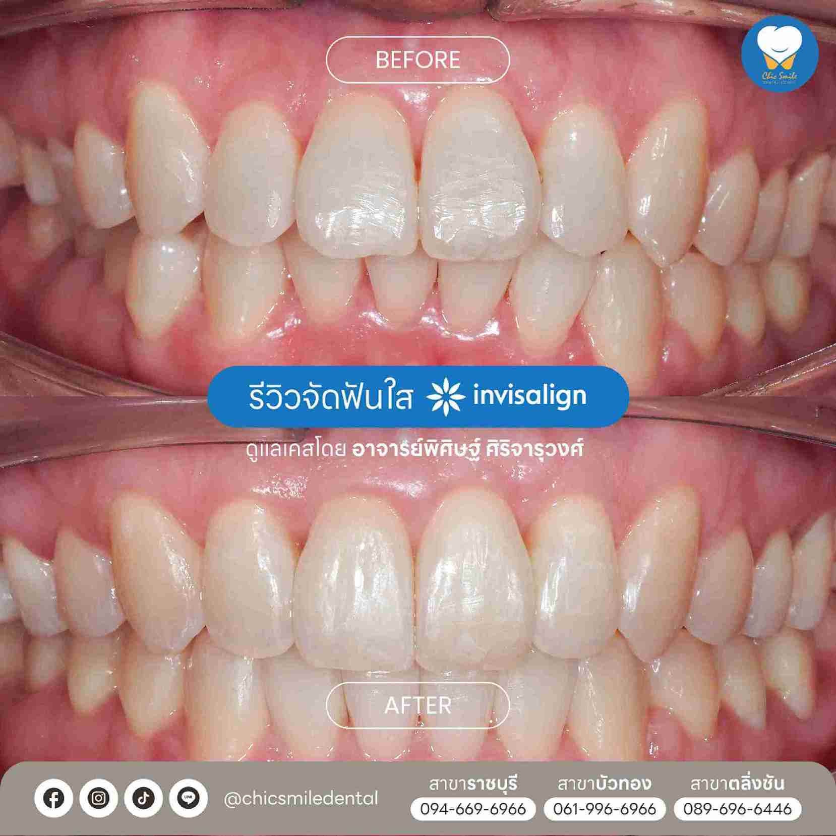 ✅ Chic - Bf&At จัดฟันใส 10-02-25-01
