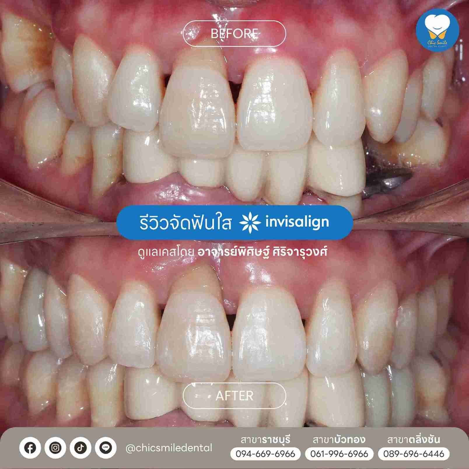 ✅ Chic - Bf&At จัดฟันใส 10-02-25-02